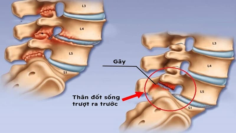gãy eo đốt sống L5