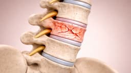 Những loại gãy xương nào thường do loãng xương gây ra?