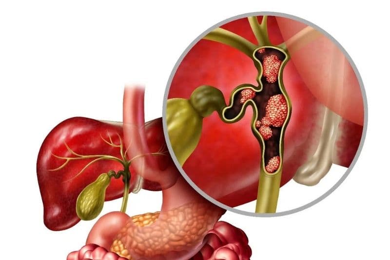 ung thư đường mật có di truyền không