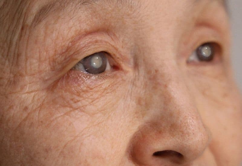 bệnh lý đục thủy tinh thể