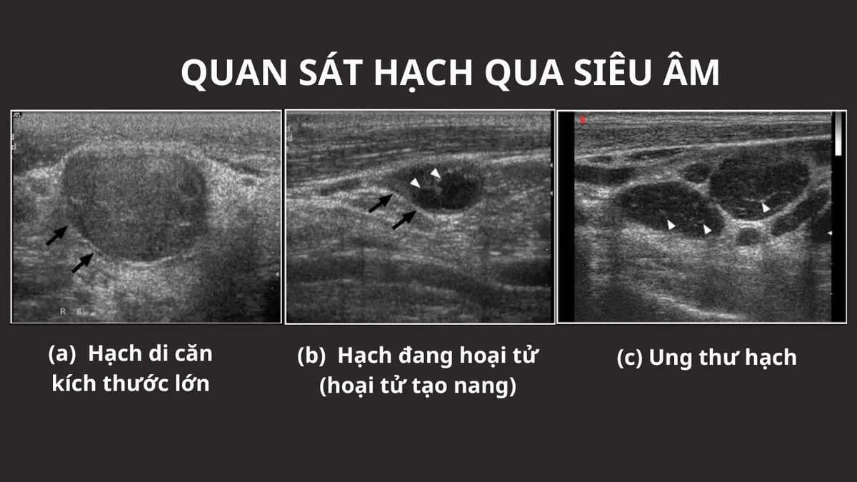 Đặc điểm hạch lao trên siêu âm