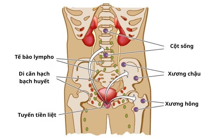 hậu quả của ung thư tuyến tiền liệt