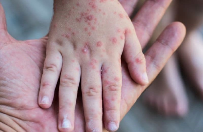 hình ảnh bệnh tay chân miệng cấp độ 3
