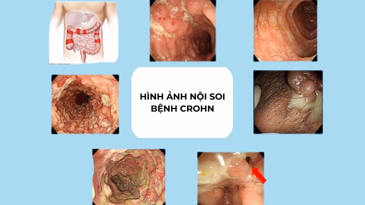 Hình ảnh nội soi của bệnh Crohn và tổn thương theo từng giai đoạn
