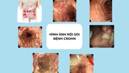 Hình ảnh nội soi của bệnh Crohn và tổn thương theo từng giai đoạn