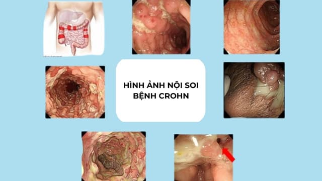 Hình ảnh nội soi của bệnh Crohn và tổn thương theo từng giai đoạn