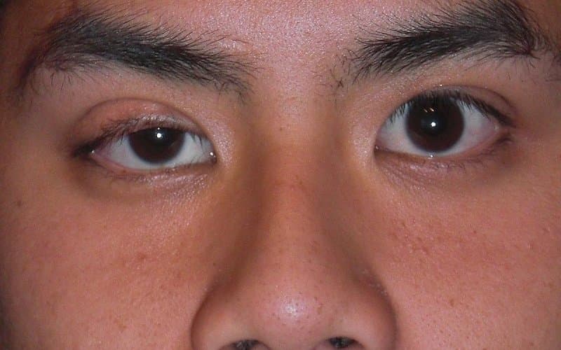 cắt hạch giao cảm có ảnh hưởng gì không