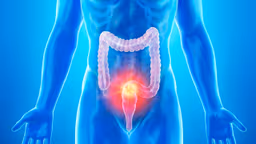 Khi nào cần sinh thiết đại tràng?