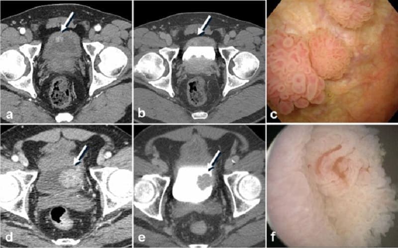 khối u bàng quang ở nam giới