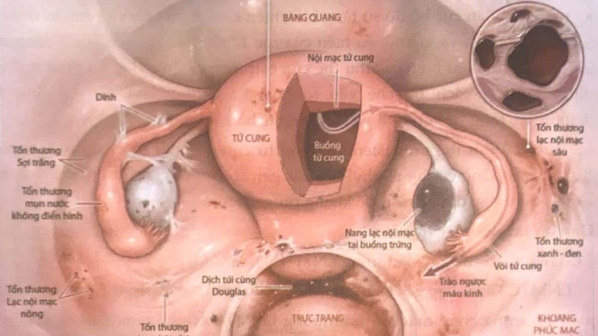 Lạc nội mạc tử cung bàng quang có nguy hiểm?