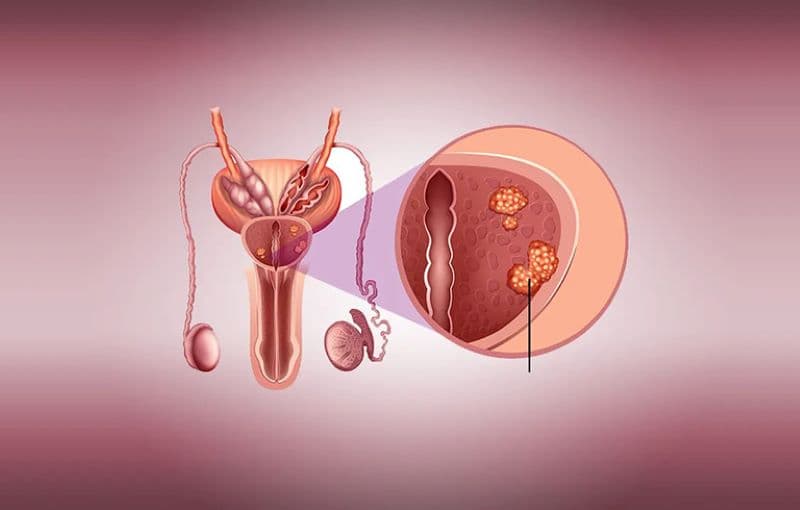 điều trị ung thư tiền liệt tuyến bằng liệu pháp hormone