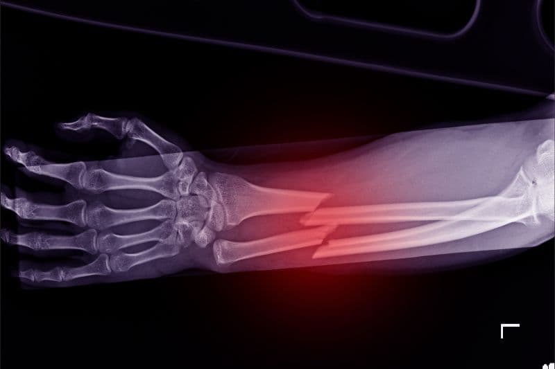 gãy xương do loãng xương