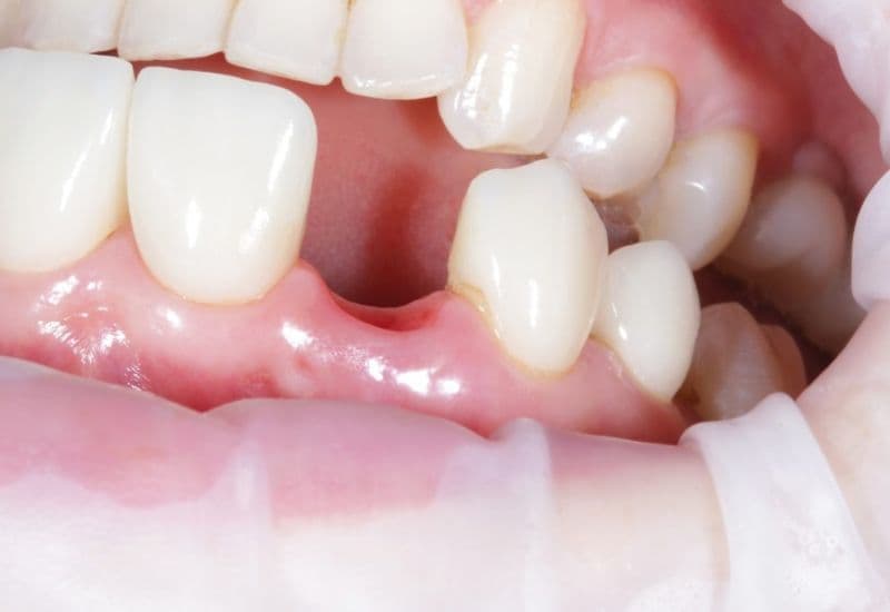 mất răng lâu năm có trồng được không