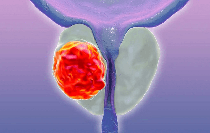 dấu hiệu ung thư tuyến tiền liệt ở nam