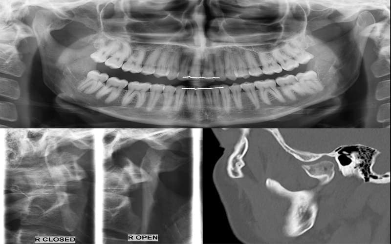 viviêm khớp thái dương hàm là gìêm khớp thái dương hàm là gì