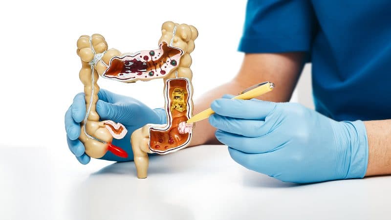 lưu ý sau khi cắt polyp đại tràng