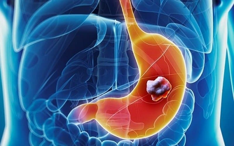 nội soi dạ dày có phát hiện ung thư không