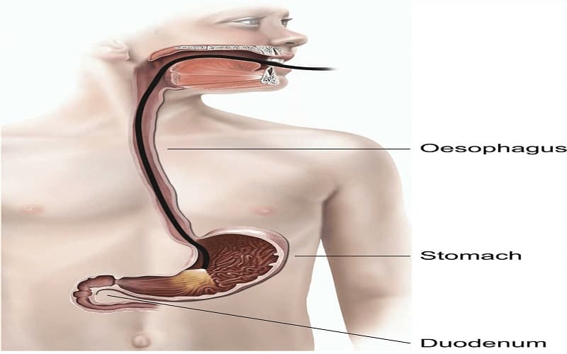 nội soi dạ dày không gây mê có đau không