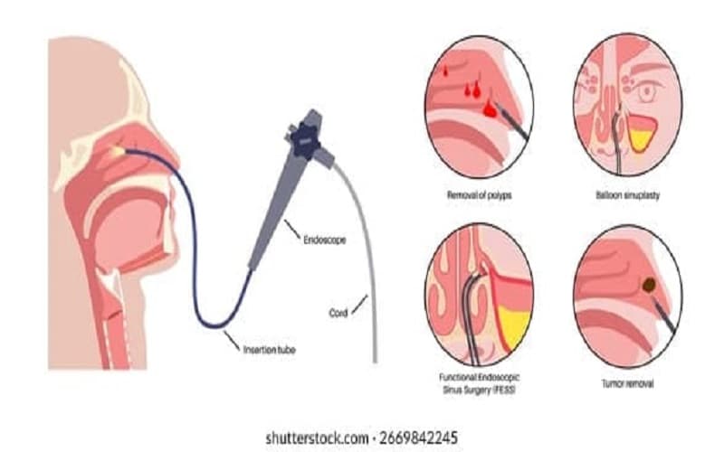 nội soi dạ dày qua đường mũi