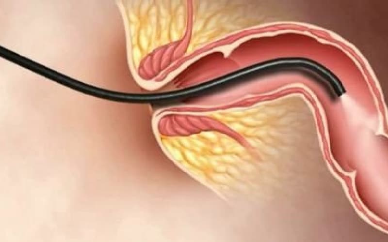 nội soi đại tràng không gây mê có đau không