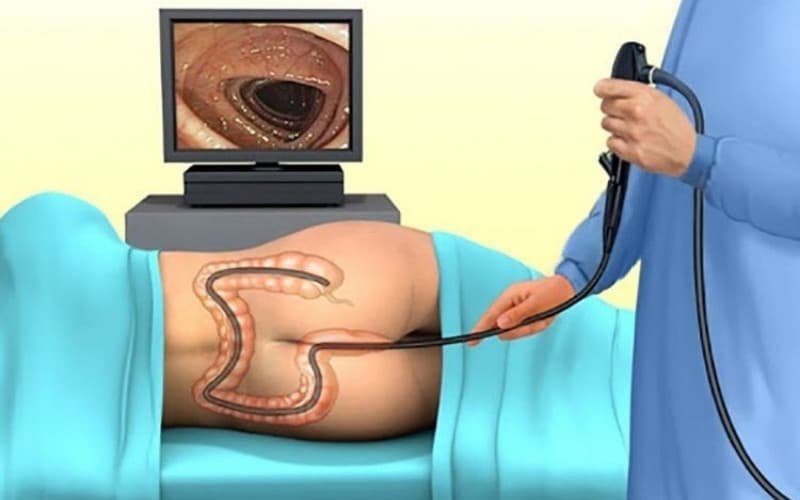 viêm đại tràng có cần nội soi không