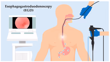 Nội soi thực quản có cần nhịn ăn không?