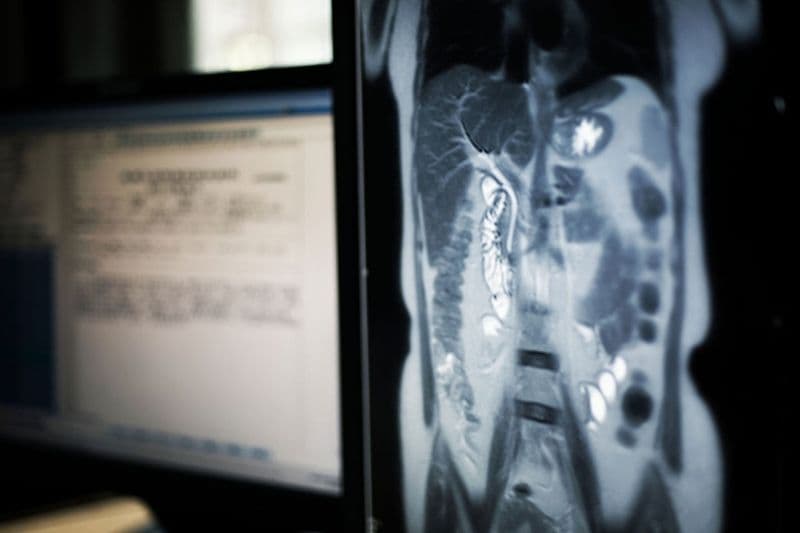 cách điều trị bệnh ung thư đường mật