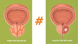 Phì đại tuyến tiền liệt có gây ung thư không?