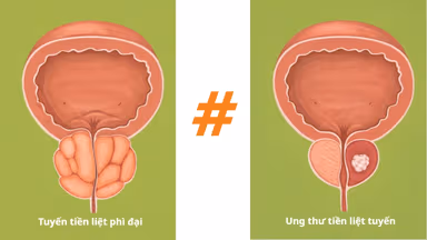 Phì đại tuyến tiền liệt có gây ung thư không?