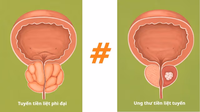 Phì đại tuyến tiền liệt có gây ung thư không?