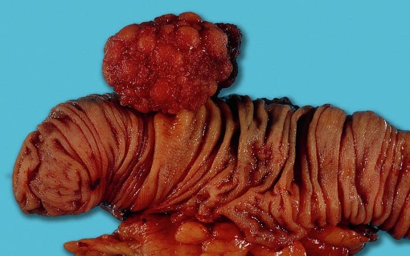 polyp đại tràng sigma không cuống