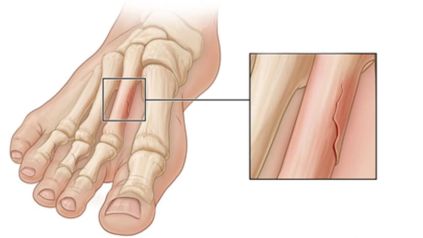Bị rạn xương ăn gì mau lành?