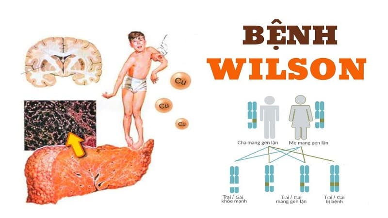 rối loạn chuyển hóa di truyền