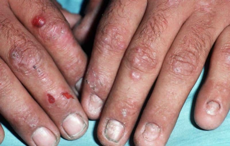 rối loạn chuyển hóa Porphyrin