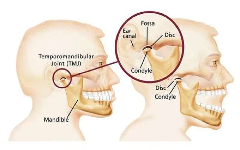 viêm khớp thái dương hàm có gây lệch mặt không