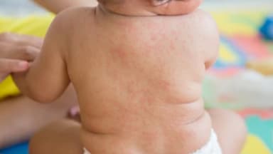 Bé sốt siêu vi có bị tiêu chảy không?