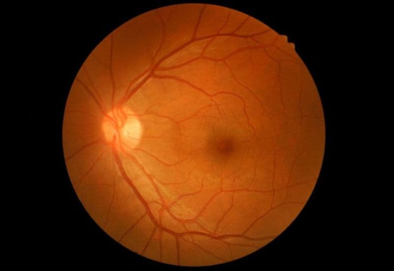 tăng nhãn áp sau mổ phaco