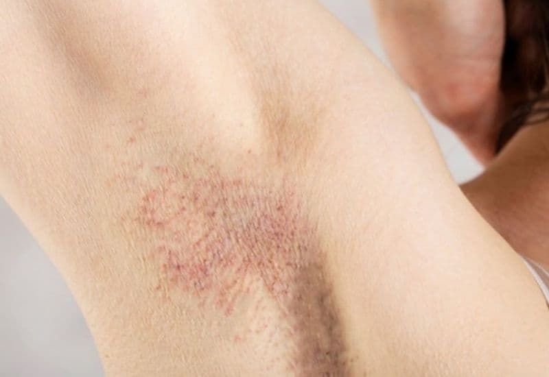 tăng tiết mồ hôi nách