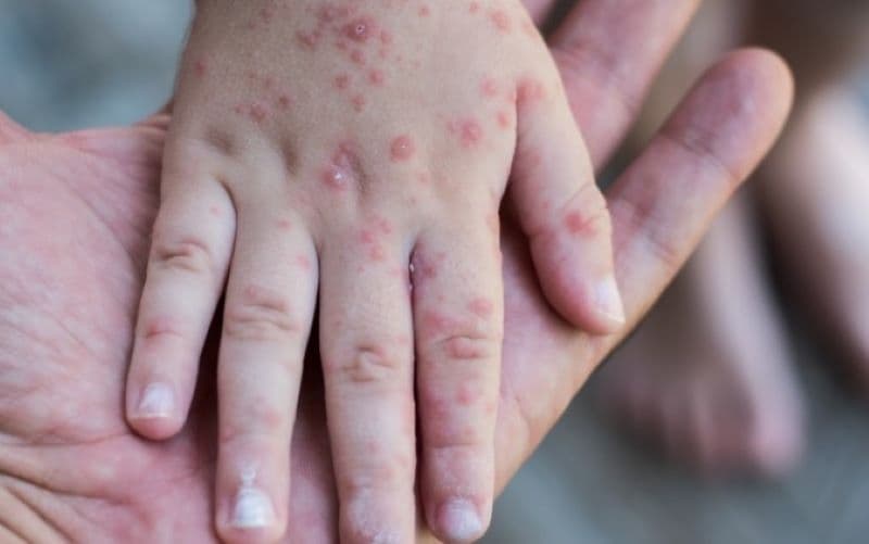 các giai đoạn tay chân miệng