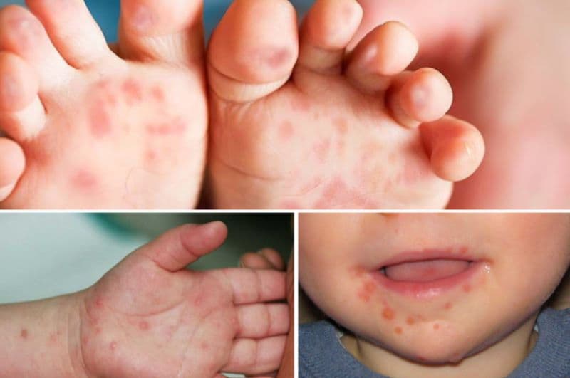 hình ảnh bệnh tay chân miệng cấp độ 2