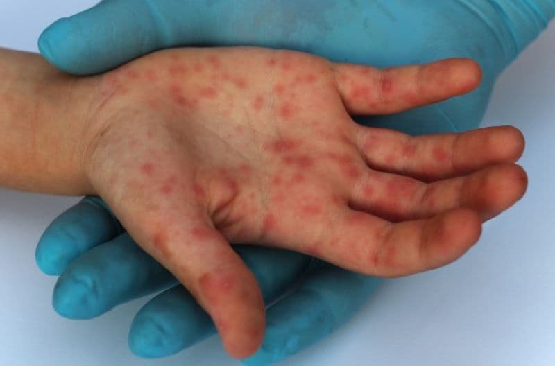 các giai đoạn tay chân miệng