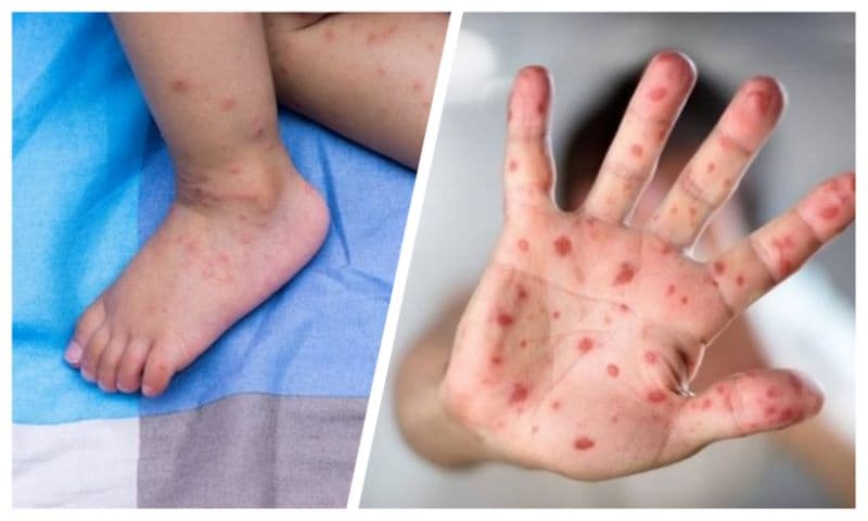 hình ảnh bệnh tay chân miệng cấp độ 3