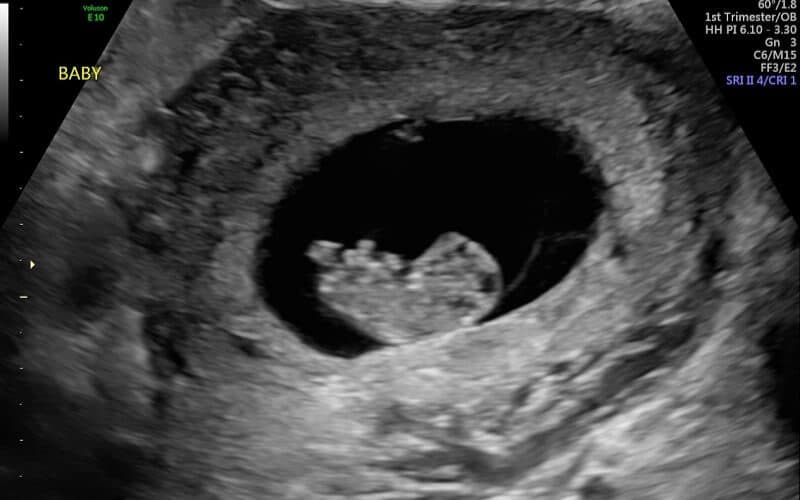 thai nhi 9 tuần tuổi phát triển như thế nào