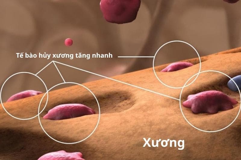 denosumab là thuốc gì