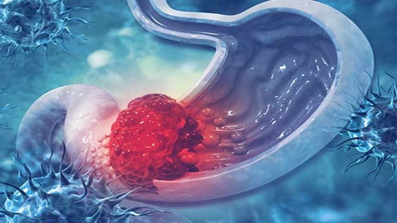 tiền ung thư dạ dày