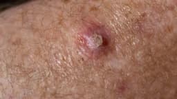 Tổn thương tế bào nội biểu mô vảy độ thấp