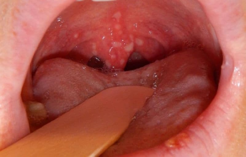 hình ảnh bệnh tay chân miệng cấp độ 3