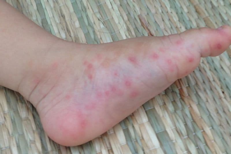 hình ảnh bệnh tay chân miệng cấp độ 3