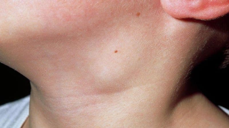 hình ảnh bệnh tay chân miệng cấp độ 2