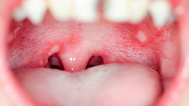 hình ảnh bệnh tay chân miệng cấp độ 2